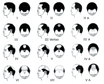 http://www.sjsu.edu/faculty/gerstman/StatPrimer/male-baldness.gif